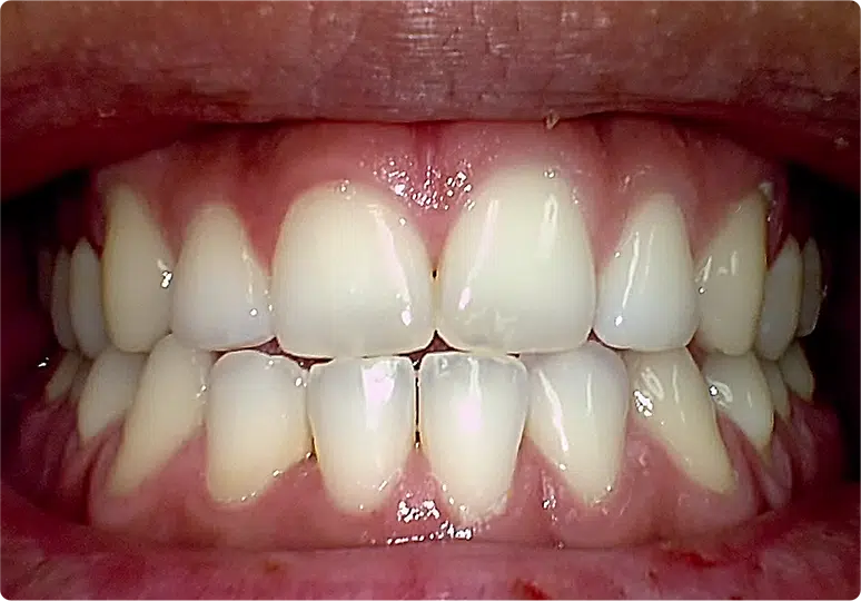 Claris i5HD Intra Oral Dental Camera Sample Pics